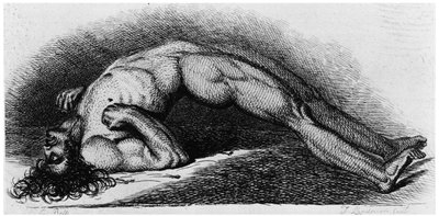 Opisthotonos: advanced case of tetanus showing muscle rigidity