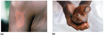 Leprosy lesions: tuberculoid and lepromatous forms