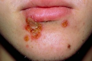 Impetigo lesions on the face