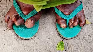 Leprosy affecting cooler body regions
