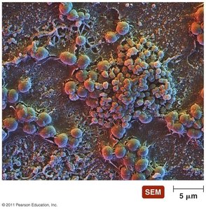 Plaque on a human tooth (biofilm)