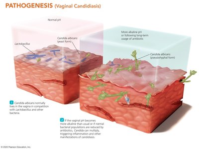 Pathogenesis of vaginal candidiasis