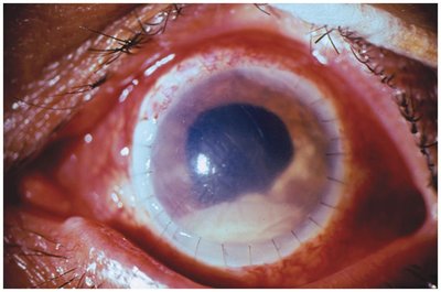 Invasive aspergilloma in the eye