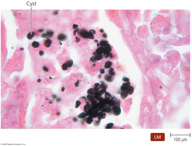 Cysts of Pneumocystis jirovecii in lung tissue