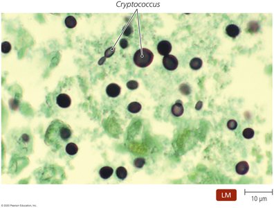 GMS stain of Cryptococcus