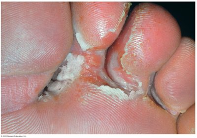 Athlete's foot (tinea pedis)
