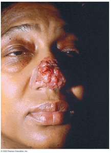 Cutaneous blastomycosis in an American woman