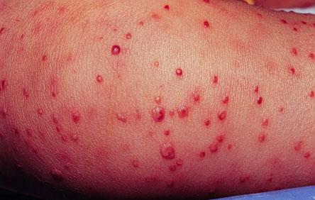 Staphylococcal folliculitis