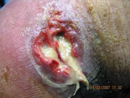 X-ray of osteomyelitis