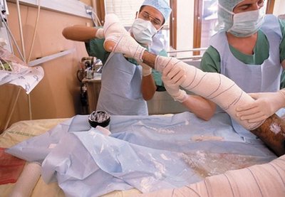 Application of silver-sulfa dressings for burn victims