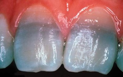 Tetracycline-induced tooth discoloration