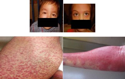 Red man syndrome, a side effect of glycopeptide drugs