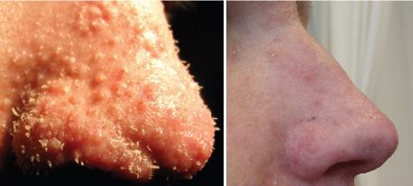 Trichodysplasia spinulosa (TS) polyomavirus lesions