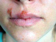 Herpes labialis (cold sore)