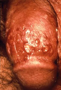 Genital herpes lesions