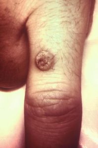 Common wart on finger