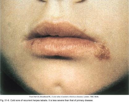 Genital herpes lesions