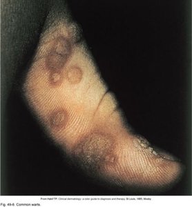 Plantar warts on foot