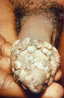 Extensive genital warts (condylomata acuminata)