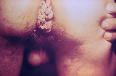 Extensive genital warts (condylomata acuminata)