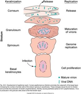 Development of papilloma (wart) in skin layers