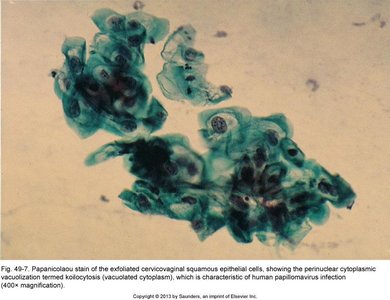Pap smear showing koilocytosis, characteristic of HPV infection