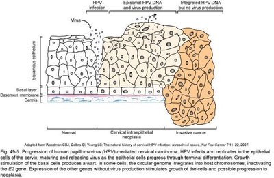 Progression of HPV-mediated cervical carcinoma