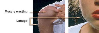 Physical signs of anorexia nervosa including lanugo and muscle wasting