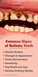 Physical signs of bulimia: ulcers, bruised knuckles, bloodshot eyes