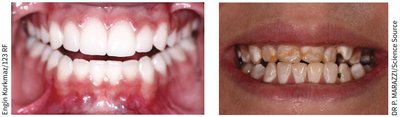 Fluorosis and healthy teeth