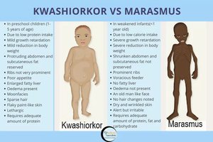 Comparison of Kwashiorkor and Marasmus