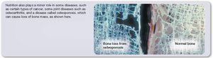 Bone loss from osteoporosis versus normal bone