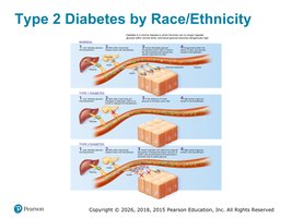 Type 2 diabetes by race/ethnicity