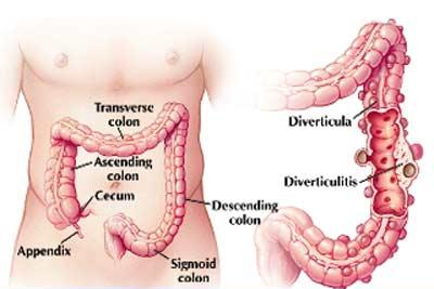 Diagram of diverticulitis in the colon