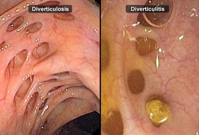 Endoscopic view of diverticulosis and diverticulitis