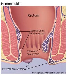 Diagram of hemorrhoids in the rectum