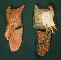 Comparison of a normal lung and a smoker's lung