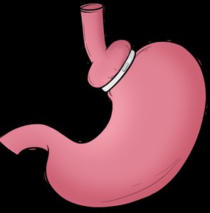 Gastric banding surgery