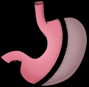 Gastric sleeve surgery