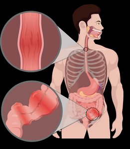 GI tract damage in bulimia