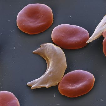 Sickle cell anemia: altered protein shape in red blood cells
