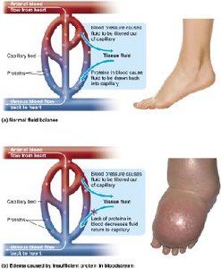 Normal fluid balance and edema caused by insufficient protein