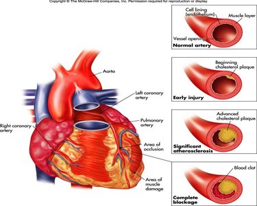 Diagram of atherosclerosis progression in arteries
