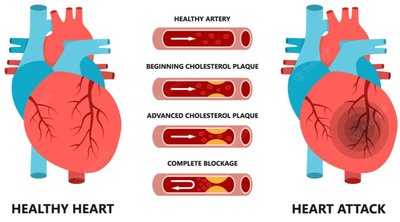 Peripheral artery disease diagram