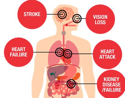 Complications of hypertension diagram