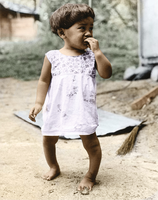 Child with rickets due to vitamin D deficiency