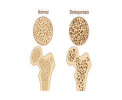 Normal vs. osteoporotic bone structure