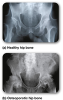 X-rays of healthy and osteoporotic hip bones