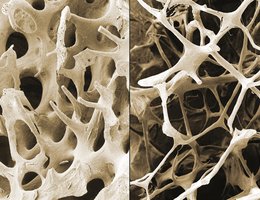Microscopic comparison of normal and osteoporotic bone