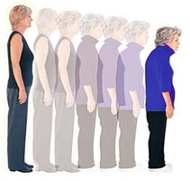 Progressive height loss in osteoporosis
